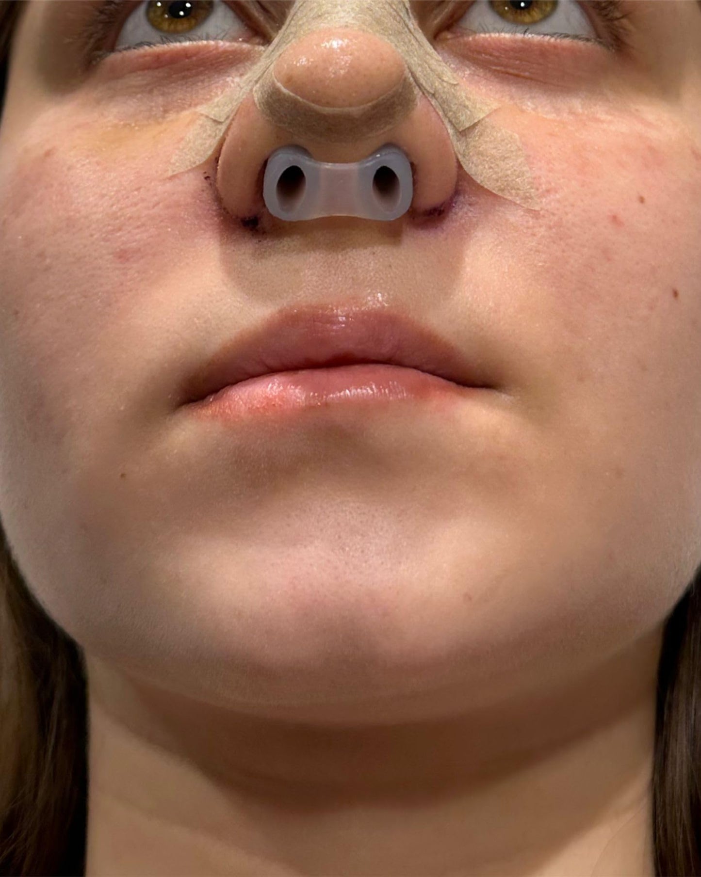 Nostril Retainer | Nostril Retainer for Rhinoplasty Recovery | Nose Retainer for Surgery | Nose Shaper & Support Device | 100% H