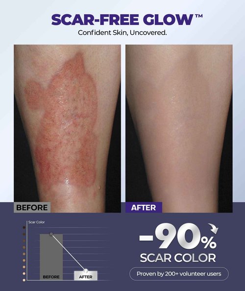 Silicone Scar Cream with 6.7% Active Ingredients, Scar Gel Visible in 2 Weeks, Moisturizing Scar Removal Clinically Show for Surgical, C-Section, Keloid, Acne & Burn Scars, Stretch Mark Cream(55ML)