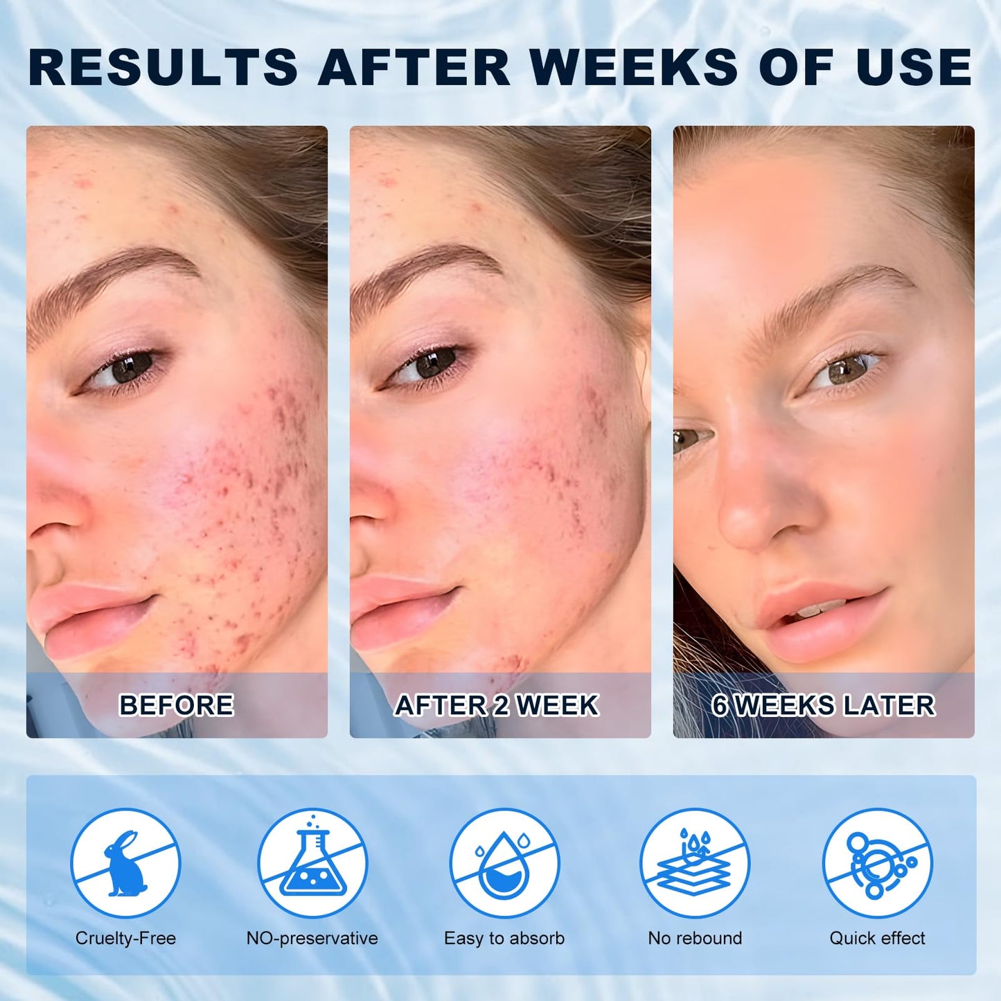 Azelaic Acid 10% Cream for Face - Acne Cream for Rosacea Reducing Relief Pimple Breakouts Blackhead Pigmentation and Redness - A