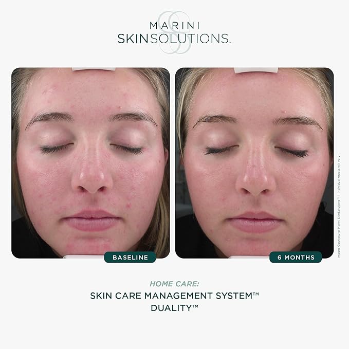 Marini SkinSolutions Duality - Benzoyl Peroxide 10% Acne Treatment Cream & Anti-Aging Retinol - Reduce the Appearance of Acne, Blemishes, Fine Lines, Wrinkles - Cruelty Free - Made in the USA - 1 oz