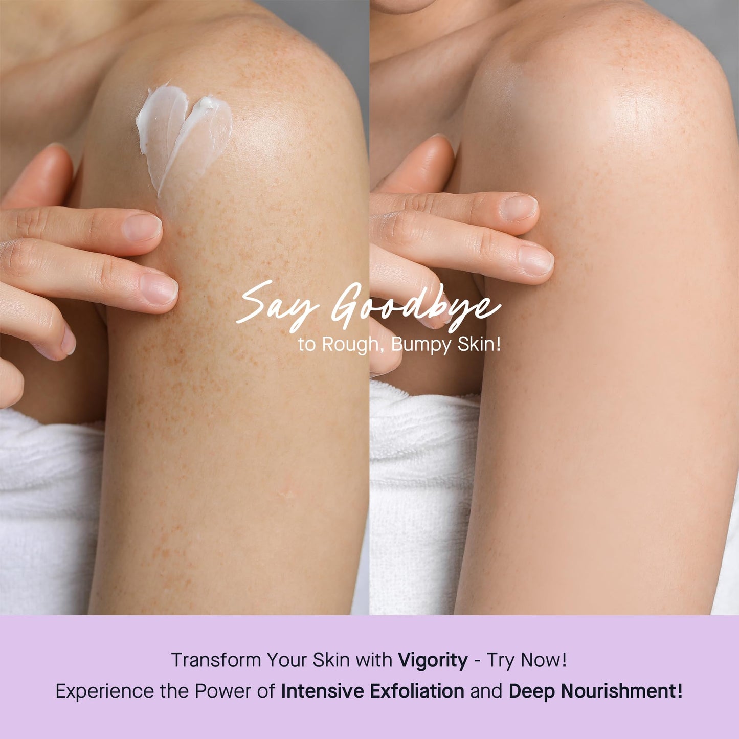 Vigority Keratosis Pilaris Treatment Cream with Lactic Acid - KP Body Bump Exfoliating Moisturizer for Rough, Bumpy, Dry & Flake