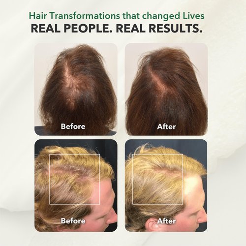 HairSmart Hair Growth Shampoo and Conditioner | Paraben & Sulfate Free with Ayurvedic Herbs | Hair Loss Treatments for Women and Men | Volumizing Shampoo and Conditioner, Pack of 2, 100ml Each