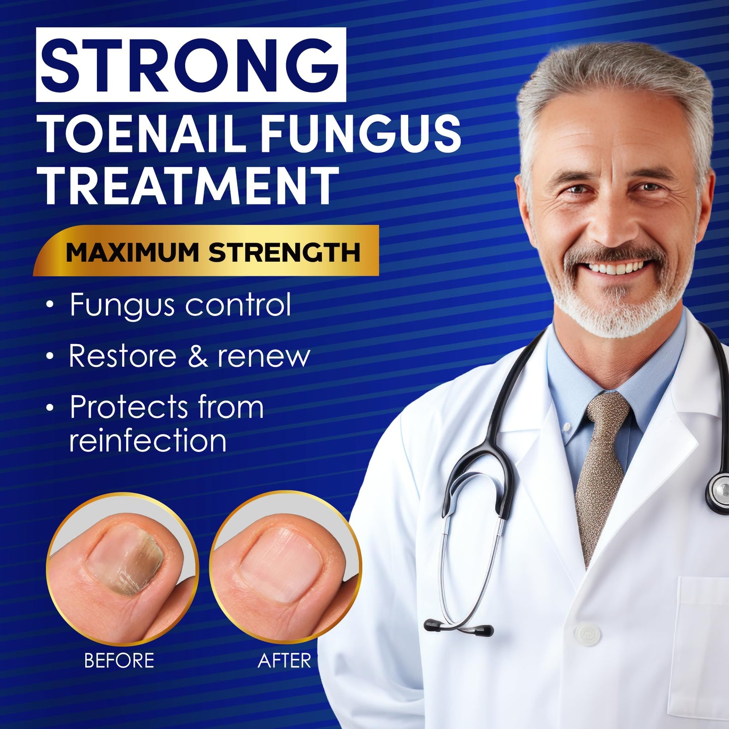 Toenail Fungus Treatment Extra Strength - Nail & Toe Solution with Undecylenic Acid 25% and Tea Tree Oil