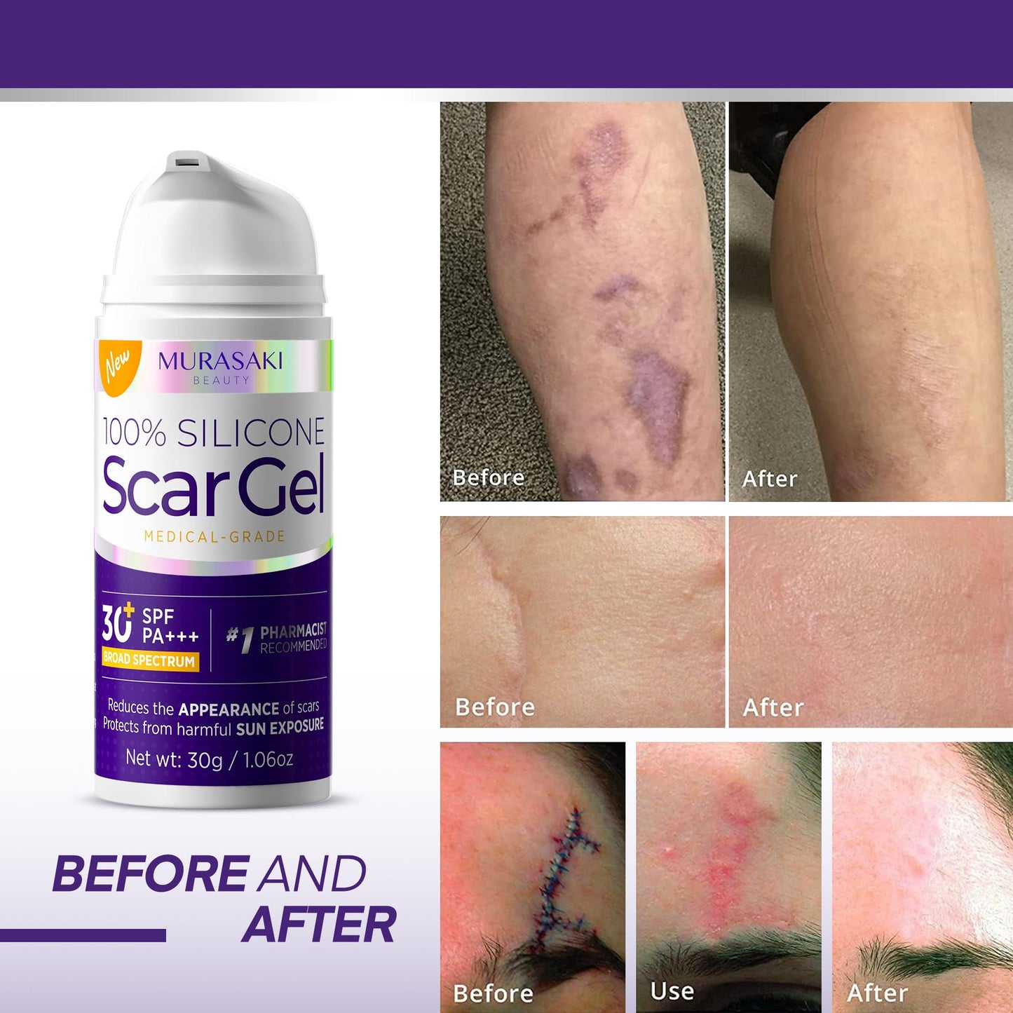 Silicone Scar Gel Scar Cream: SPF 30 Advanced Medical-Grade Formula for Surgical Scars, C-Section, Stretch Marks, Acne, Burns, K
