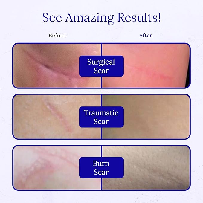 Rejuvaskin RejuvaSil Silicone Scar Gel, Scar Treatment for Surgical Scars, Burns, Keloids, Acne Scars on Face & Body, 15ml
