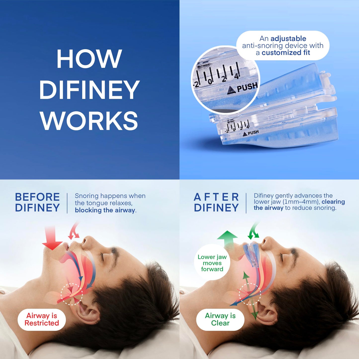 Difiney Anti Snoring Device: FDA-Cleared Snoring Solution – Adjustable Snore Stopper Mouth Guard for Men & Women – Anti Snoring Mouthpiece to Improve Sleep – Reusable Night Use