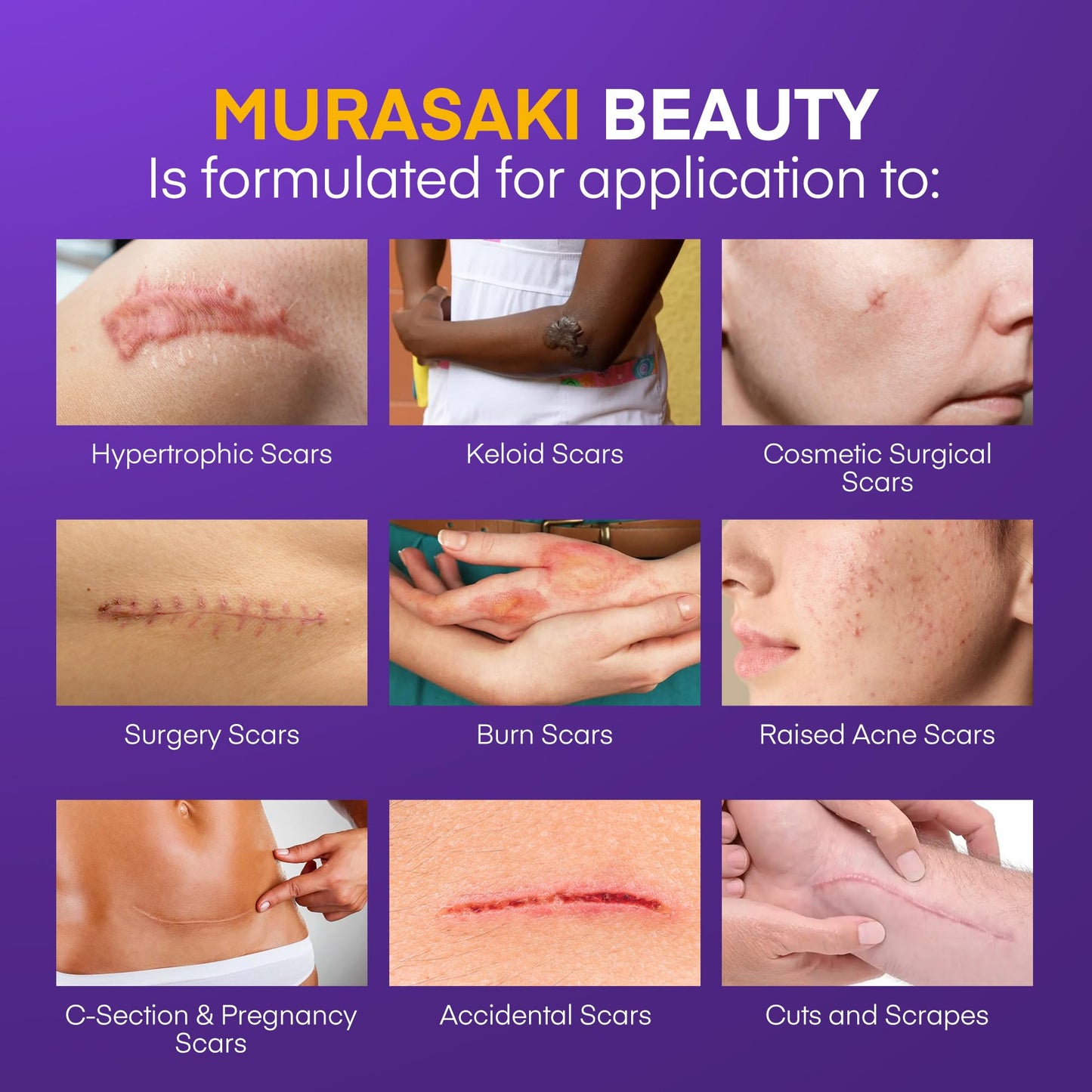 Silicone Scar Gel Scar Cream: SPF 30 Advanced Medical-Grade Formula for Surgical Scars, C-Section, Stretch Marks, Acne, Burns, K