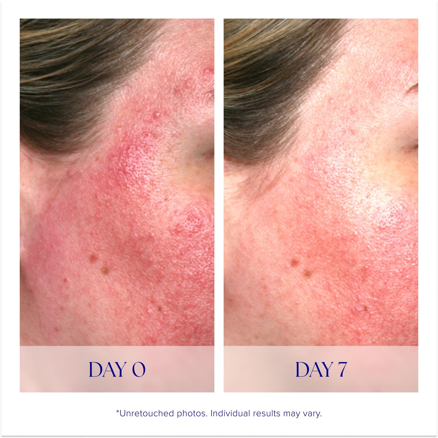 iS CLINICAL Pro-Heal Serum Advance+ Antioxidant-Rich Serum With Vitamin C, E, and A for Redness, Irritation, Wrinkle-Smoothing,