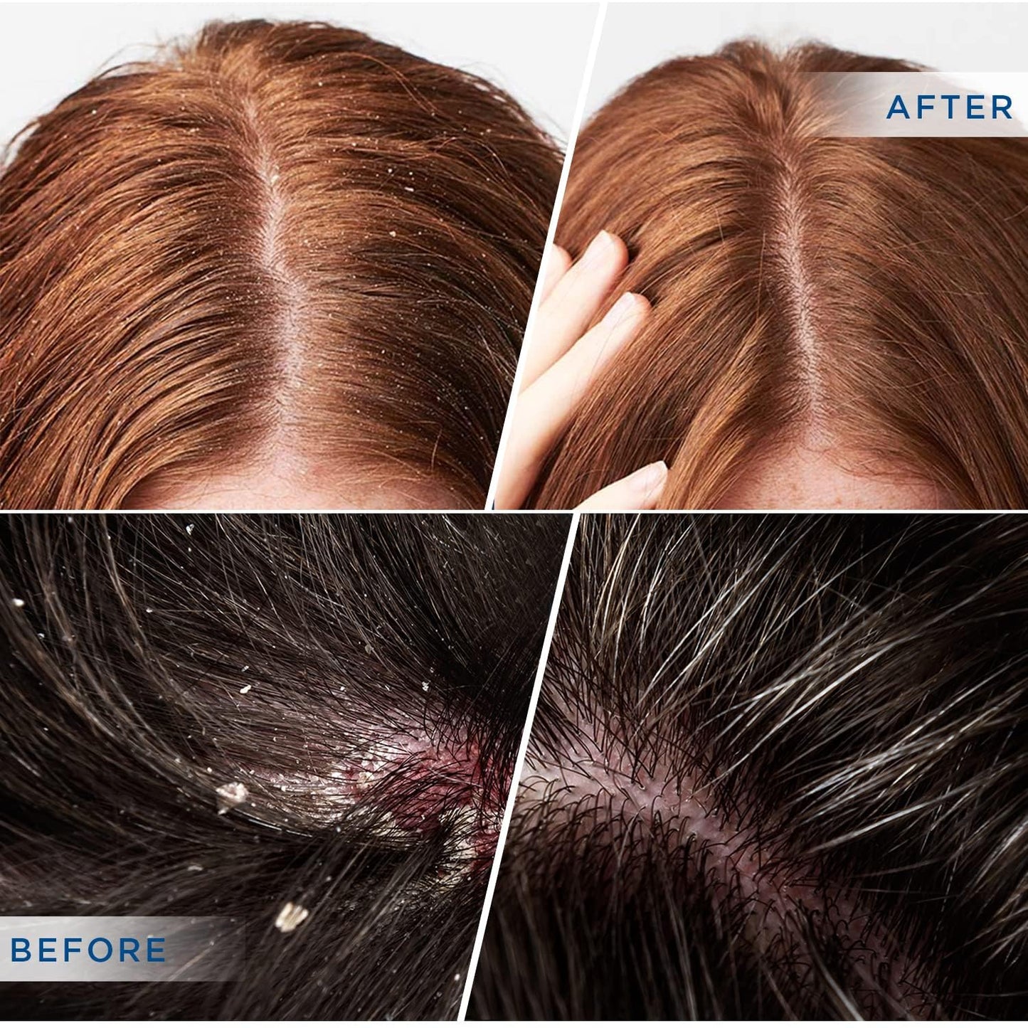 DERPHEA Psoriasis Shampoo: Seborrheic Dermatitis Shampoo, Folliculitis - for Eczema Dandruff Itchy Dry Scalp - Safe Ingredients