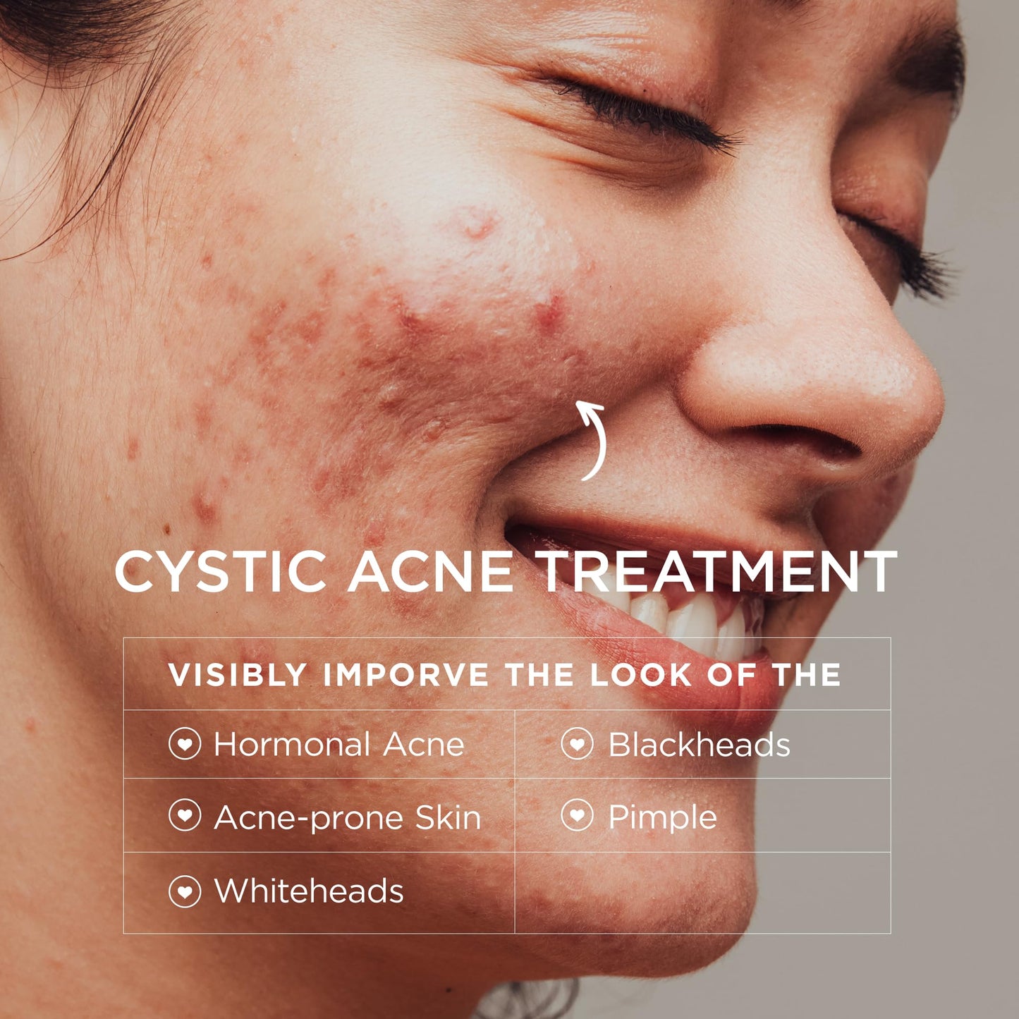 BellamiLuxx Cystic Acne Treatment for Face: Hormonal Acne Treatment Cream for Teens & Adults - Salicylic Acid & Tea Tree Oil Pimple Spot Remover - Anti-Acne Moisturizer Reduces Redness, Blemishes